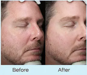 IPL Photofacial