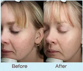 Laser Rosacea Treatment