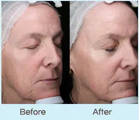 Laser Skin Rejuvenation