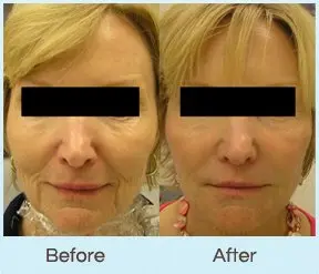 Cosmetic Injectables